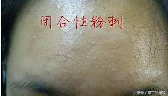 青少年脸上的粉刺怎么去除,去除脸上粉刺和油的最好方法