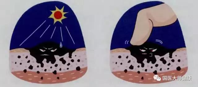 突然长出来的痣要切吗,乳房突然长痣会癌变吗