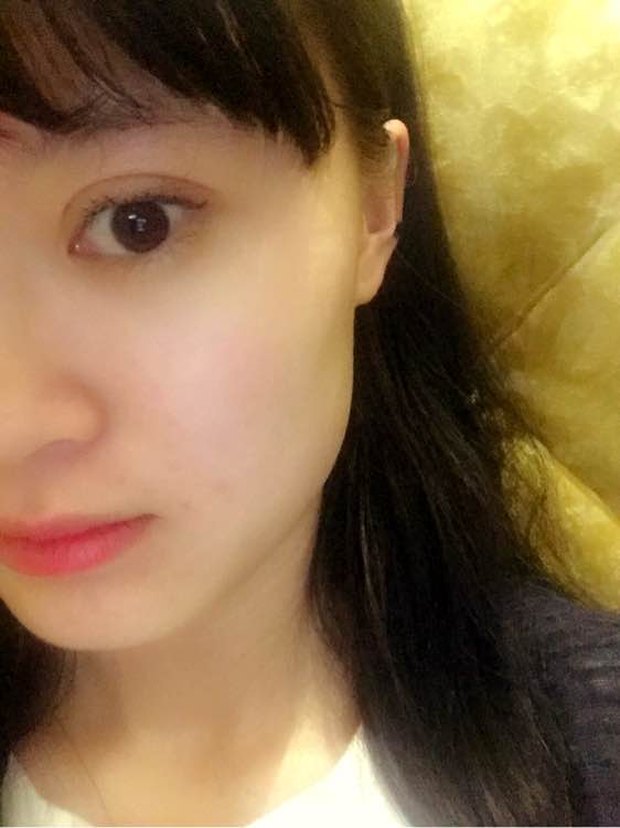 全切双眼皮一个月还是肿怎么回事,全切双眼皮一个月还肿是怎么回事