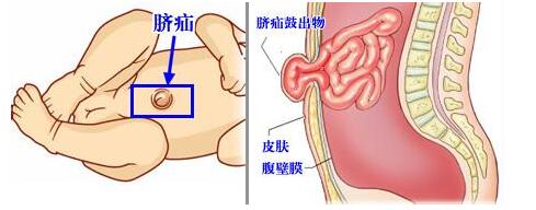 小儿脐疝脐带四周会鼓起吗,新生儿腹股沟脐疝如何用硬币按压