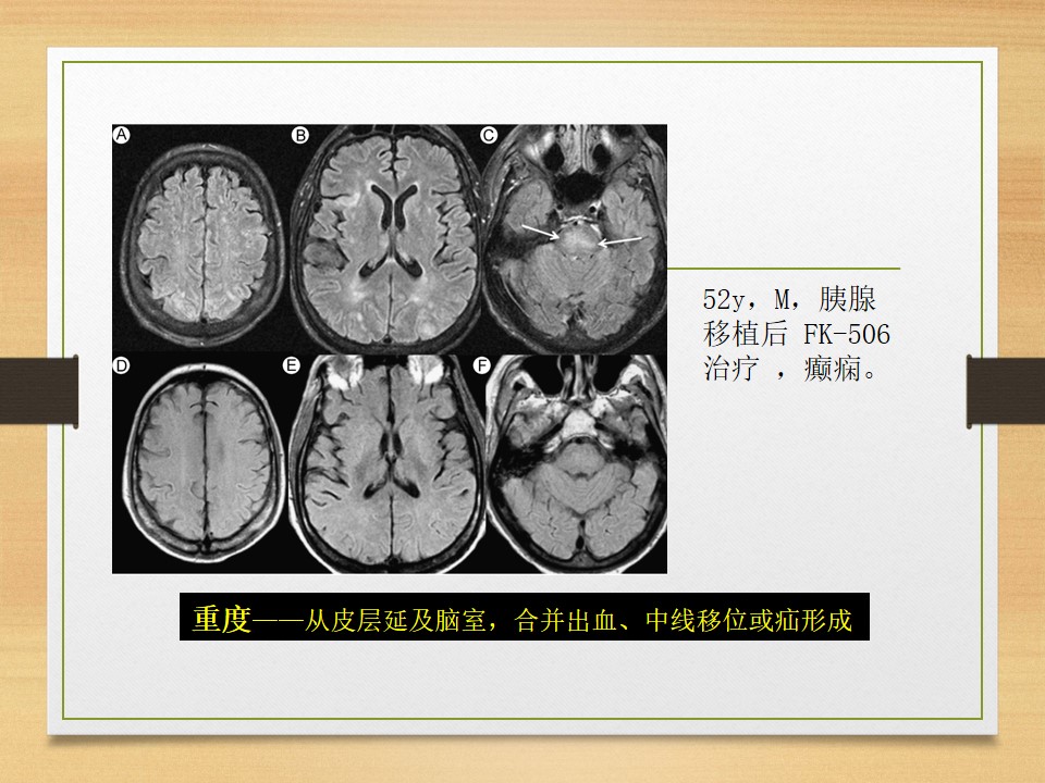 可逆性后部白质脑病综合征中央型,可逆性后部白质脑病综合征啥症状