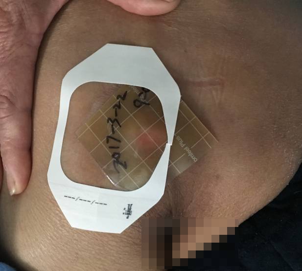 压疮贴的正确使用方法,压疮中药外敷治疗方法