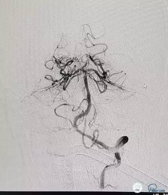 椎动脉狭窄支架植入术需要多少钱,颅内动脉狭窄支架手术后哪些症状