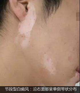 不是白癜风的白斑能查出是什么吗,不是白癜风的白点是啥