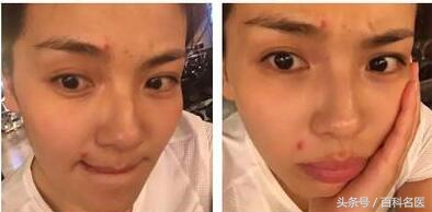 嘴巴周围经常长痘痘是什么原因,下巴和嘴巴周围起痘痘什么原因