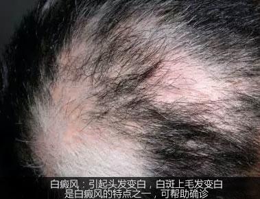 不是白癜风的白斑能查出是什么吗,不是白癜风的白点是啥