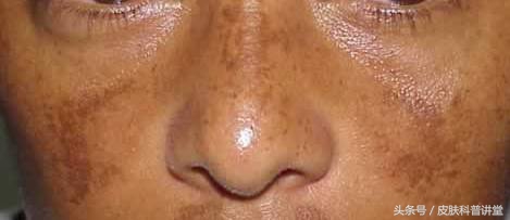 褐斑的原因和治疗方法,褐斑最佳治疗方法