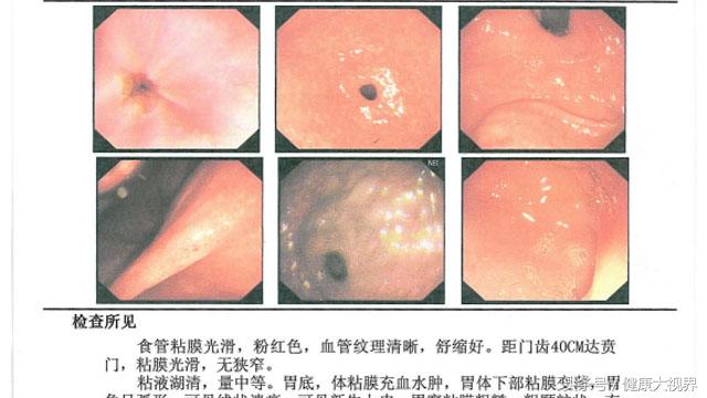 胆汁反流胃炎治疗方法患者讲述,胆汁反流性胃炎治愈方法药方