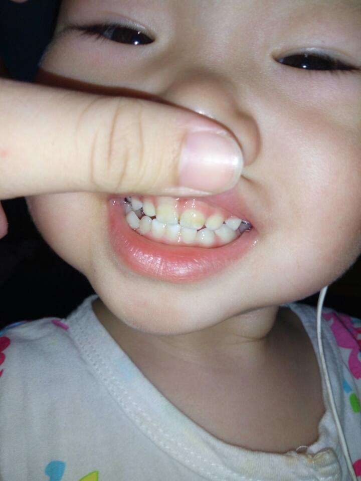 孩子刷牙了可是牙还是黄的,宝宝不爱刷牙怎么预防龋齿