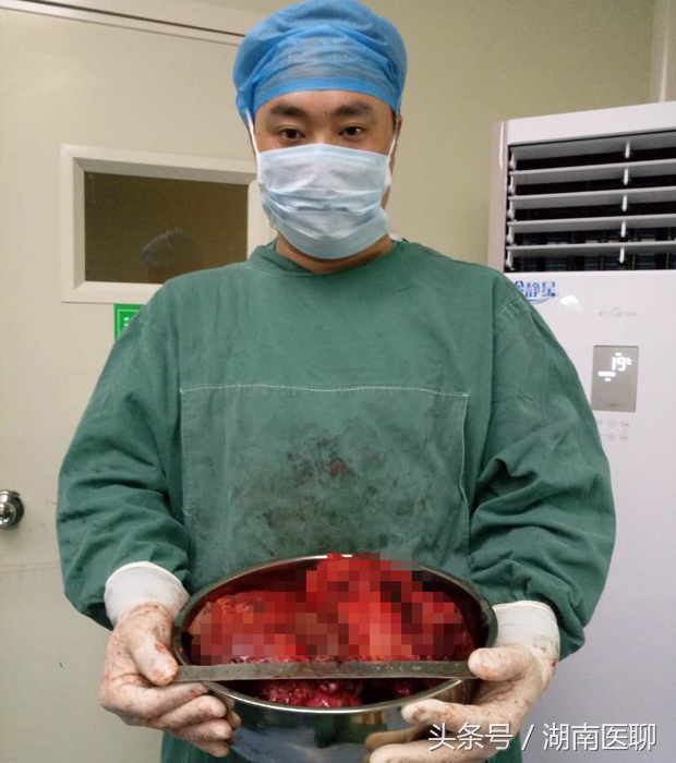 湖南女子腰间长“足球”大肿瘤进超市被怀疑偷东西