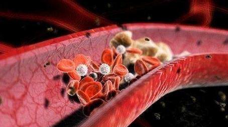 糖尿病脑梗不忌口容易引发心梗吗,脑梗脑血栓糖尿病