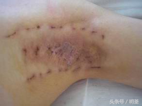 狐臭手术后遗症有哪些症状表现,切除腋下狐臭手术有什么后遗症