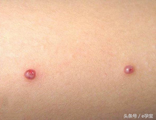 2岁女童反复高烧查不出原因,2岁娃高烧不退