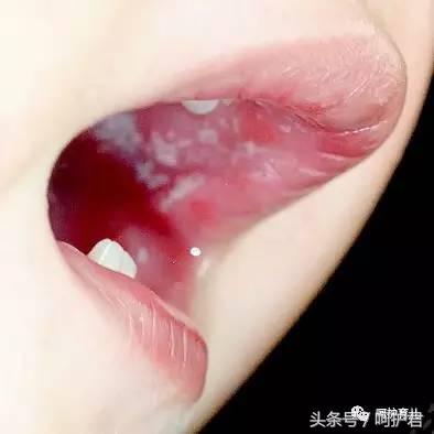宝宝嘴里经常出现白色东西，喂奶哭闹，这是怎么了？