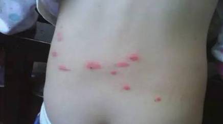 回老家身上长红疙瘩怎么回事很痒,五岁小孩身上起红疙瘩很痒怎么办