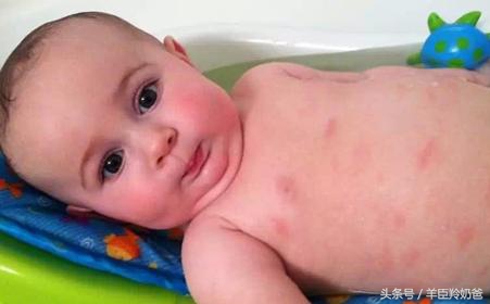 宝宝湿疹一直反复发作是什么原因,宝宝湿疹反复发作怎么办