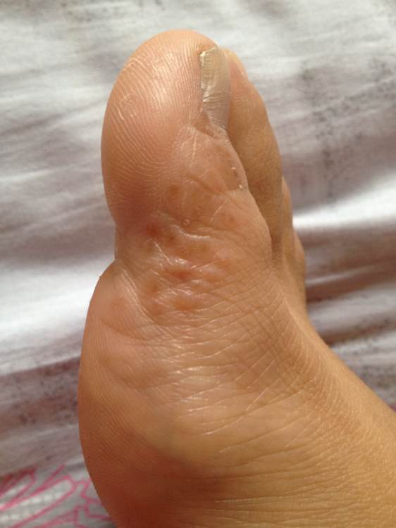 脚气无法治断根,脚气不止痒