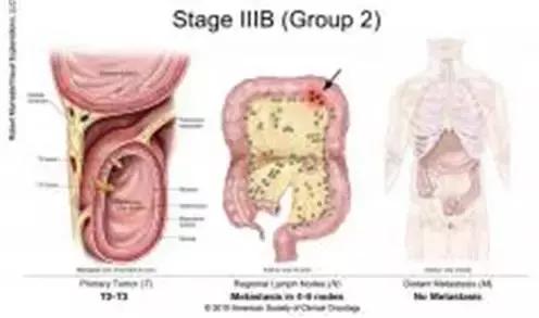 得了直肠癌怎么知道,你了解结直肠癌吗