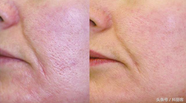 改善毛孔粗大最简单有效的方法,如何有效改善毛孔粗大的方法