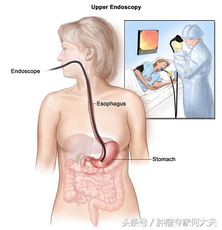 食管癌筛查与早诊早治指南,胃癌肠癌早期筛查
