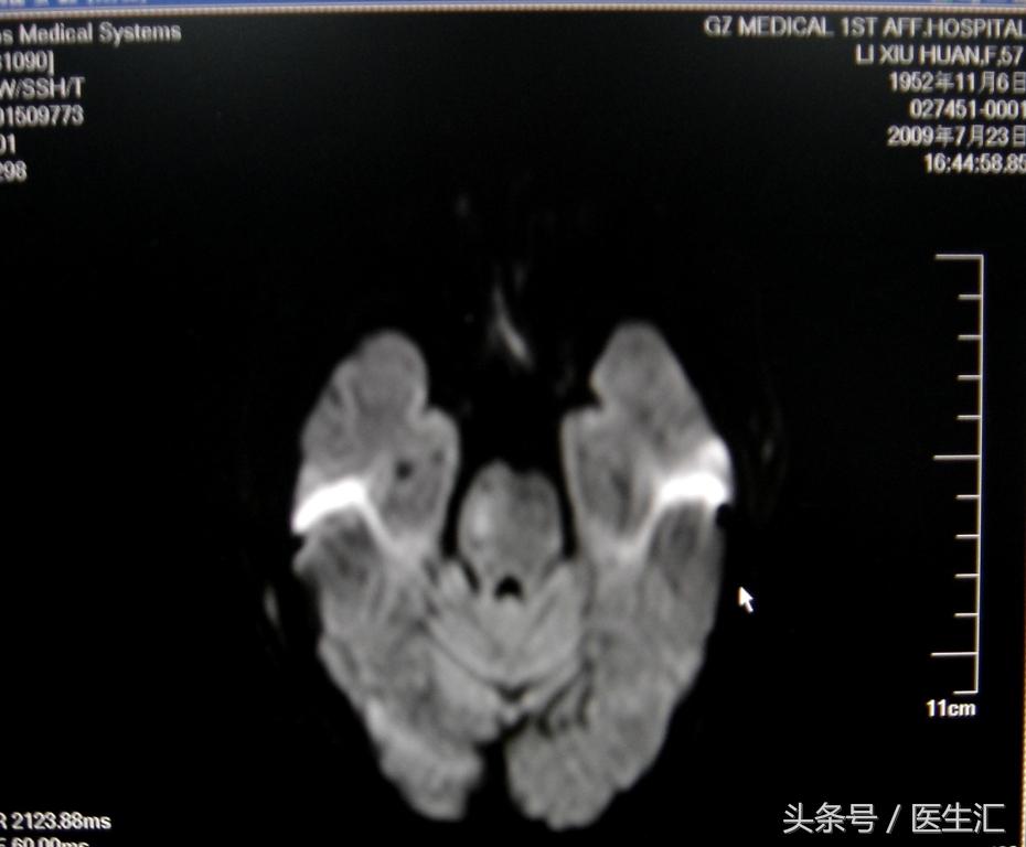 脑溶栓治疗一般多少钱,溶栓治疗需要多少费用