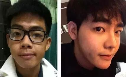 越来越多的男性整形,男士整容变帅案例