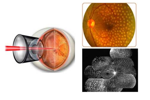 激光治疗糖尿病眼底恢复需要多久,糖尿病眼底出血打激光有好处吗