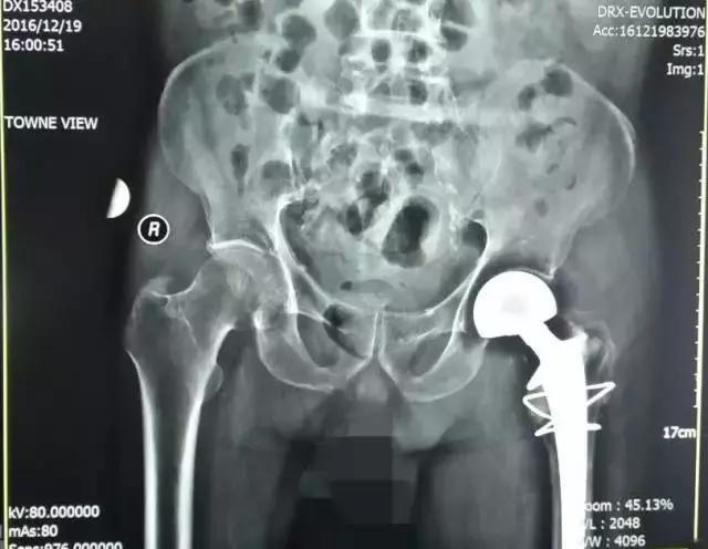 人生最后一次骨折保守治疗,髋部骨折又称人生最后一次骨折