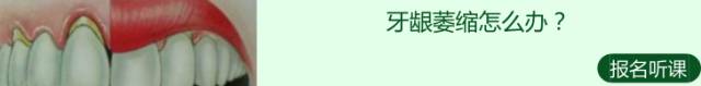 牙齿美白损伤最少的方法,想要牙齿美白这三招最管用