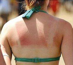 三种药膏治疗日光性皮炎,日光性皮炎什么软膏可以治疗