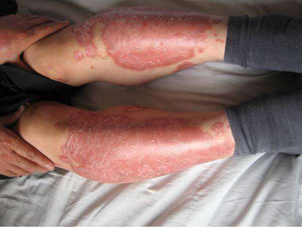 三种药膏治疗日光性皮炎,日光性皮炎什么软膏可以治疗