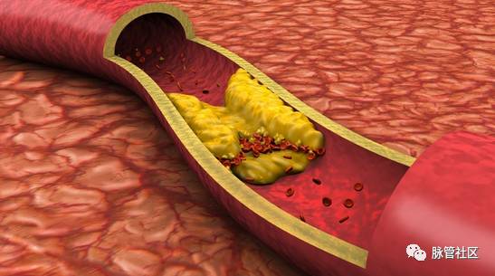 下肢发凉脚冰凉,下肢发凉是怎么回事呢