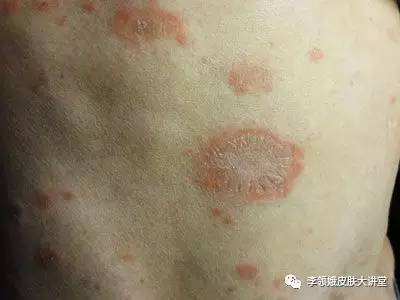 玫瑰糠疹的危害性,玫瑰糠疹有什么危害