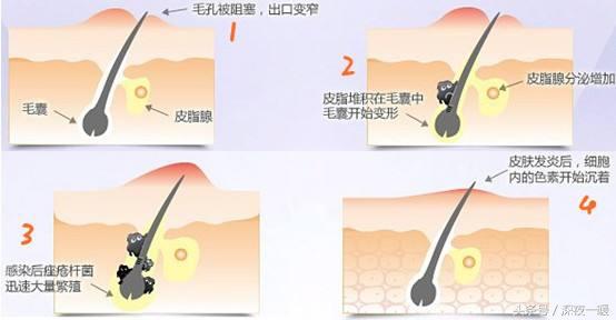 祛痘方法有哪些怎么祛痘最有效,祛痘怎么这么难啊