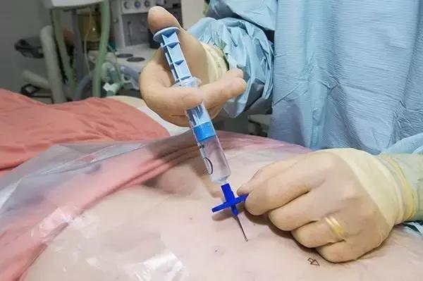 净瞎说!穿刺活检会诱发肿瘤转移,不敢做啊?