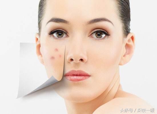 祛痘好方法更快更有效,祛痘最真实的方法
