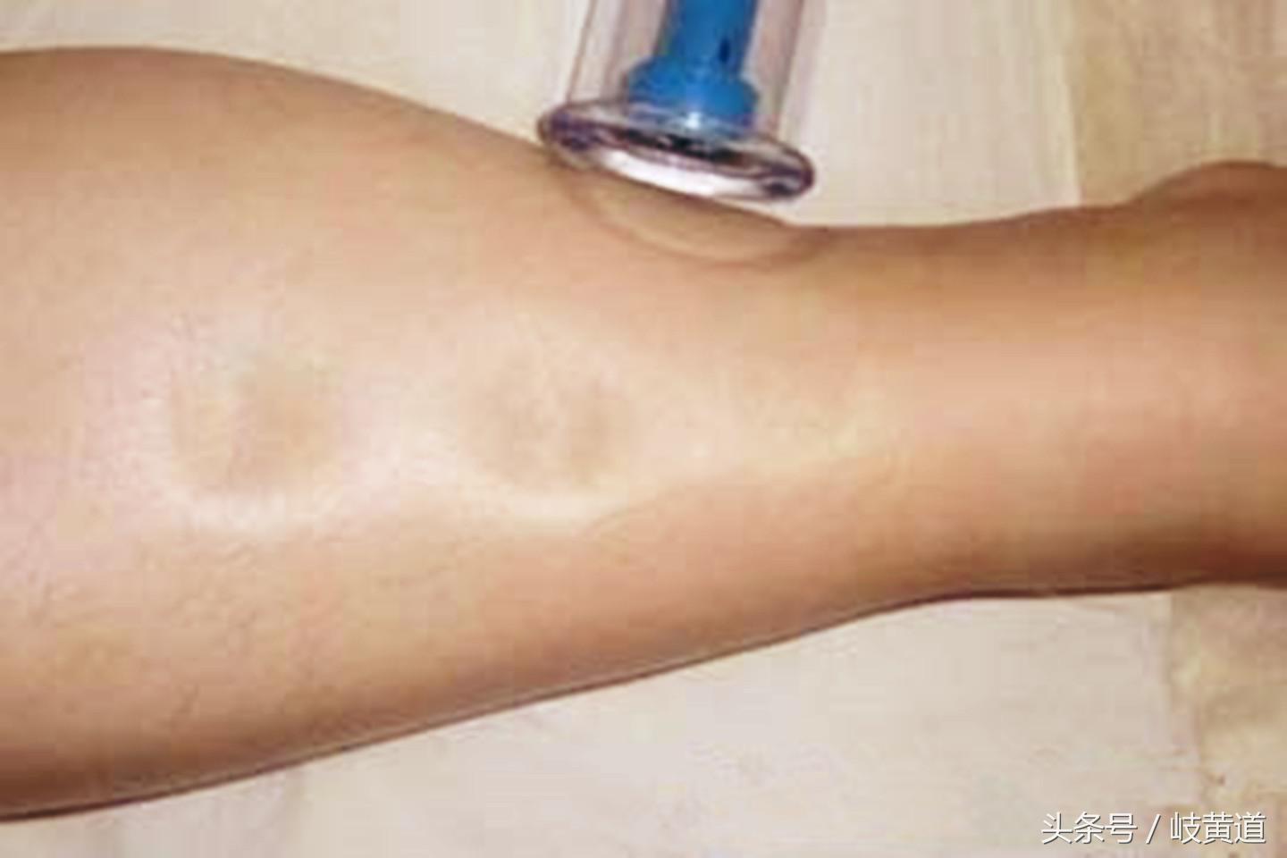 血压高，腿肿，小便还有泡沫？可能是1种肾病的征兆