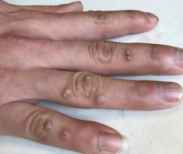 手上的瘊子如何根治,手上的瘊子怎么才能彻底治好