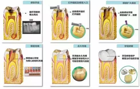 根管治疗机器多少钱,根管治疗的骗局