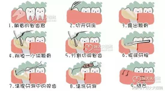 拔智齿真实体验,真人拔智齿演示