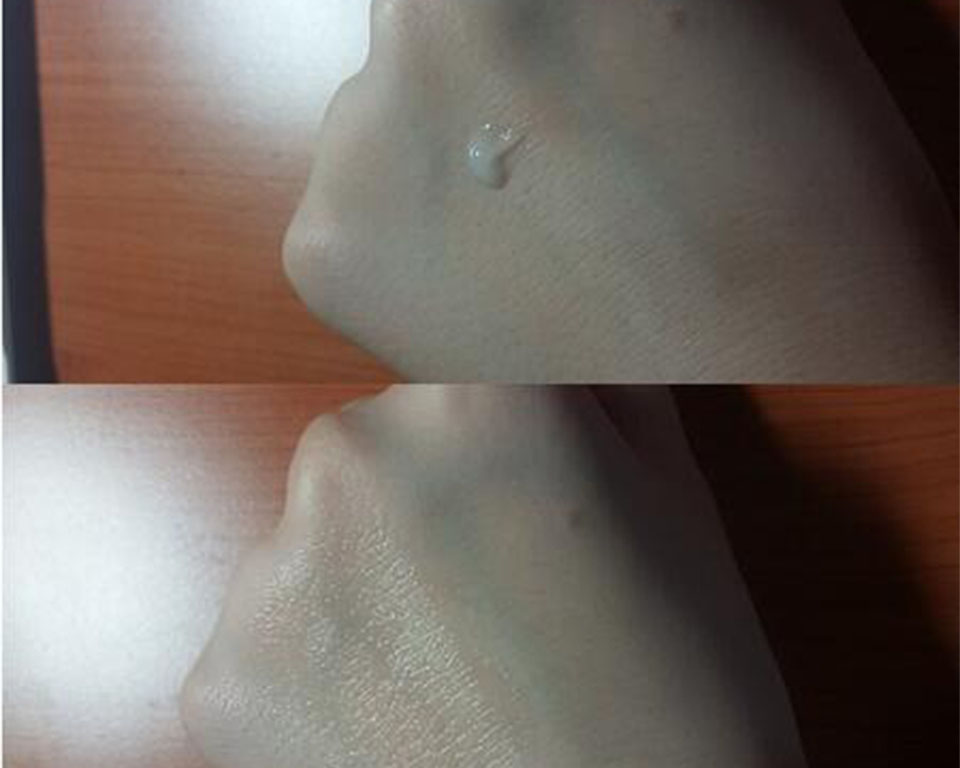 脖子后面长痘痘的原因女生,脖子后面长痘痘怎么办不疼