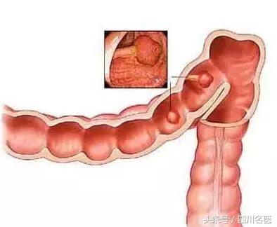 肠子里有个疙瘩一定是肿瘤吗,肠子里面长个疙瘩说是罕见病