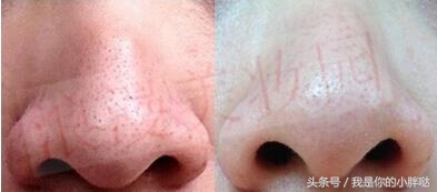 皮肤长黑头原因,皮肤长黑头和雀斑怎么办