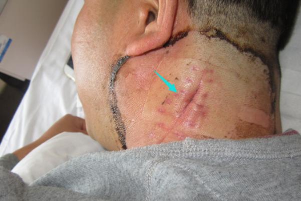 脖子淋巴结核是怎么回事,脖子上淋巴肿瘤是怎么回事