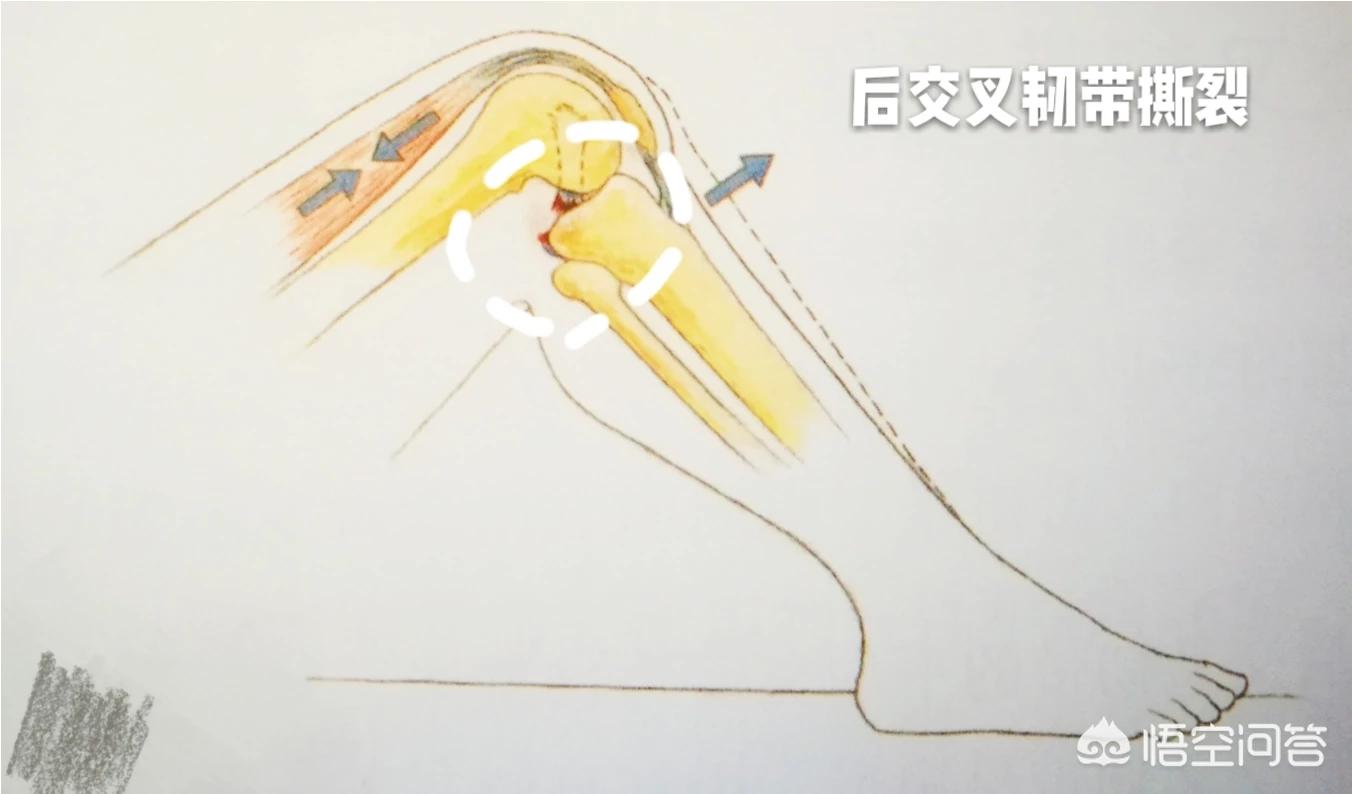 交叉韧带撕裂什么症状,交叉韧带撕裂怎么恢复正常