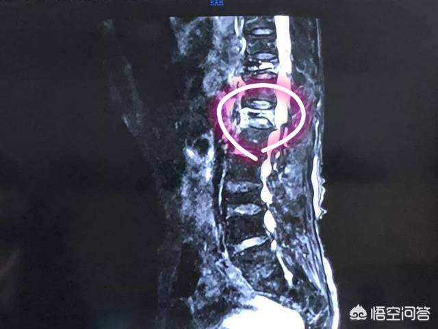 腰疼做燕飞操怎么做,腰疼做小燕飞的姿势可以么