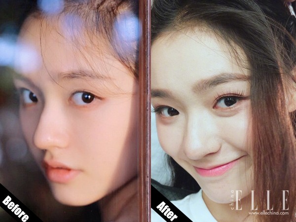 双眼皮100种整形图解,双眼皮整形全程讲解