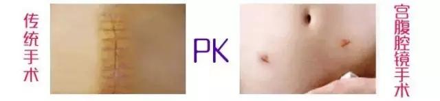 关于宫腔镜，准妈妈应该知晓的二三事