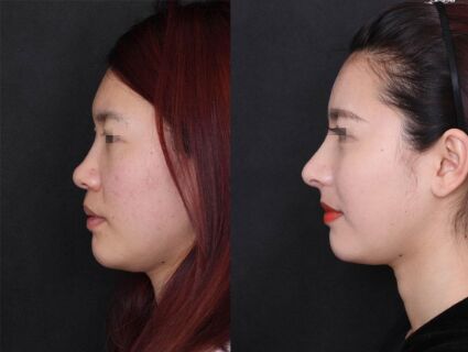 做了隆鼻手术怎么都不消肿,做隆鼻手术失败有哪些症状