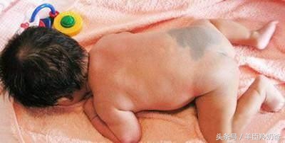 宝宝一出生脸上有一块褐色的胎记,婴儿有青色胎记是怎么回事